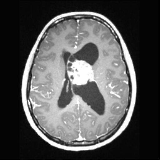 Central neurocytoma (Radiopaedia 37664-39557 Axial T1 C+ 48).png