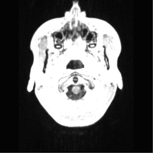 File:Central neurocytoma (Radiopaedia 37664-39557 Axial T1 C+ 6).png