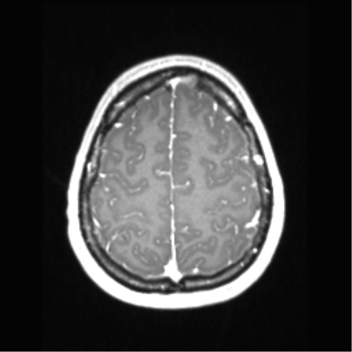 Central neurocytoma (Radiopaedia 37664-39557 Axial T1 C+ 65).png