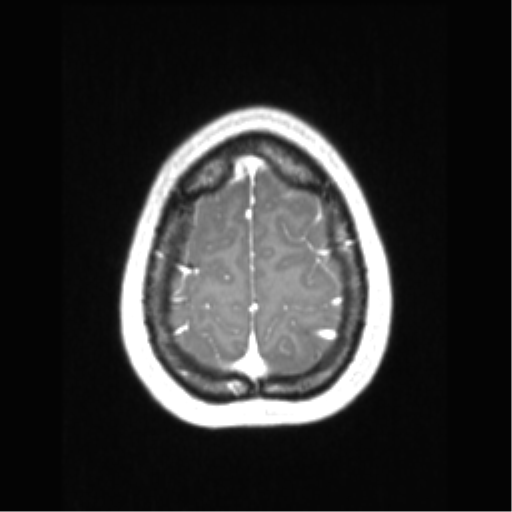 Central neurocytoma (Radiopaedia 37664-39557 Axial T1 C+ 70).png