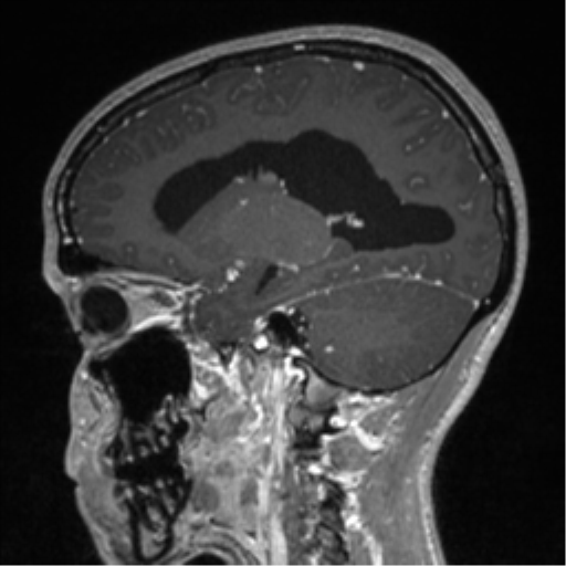 Central neurocytoma (Radiopaedia 37664-39557 Sagittal T1 C+ 36).png