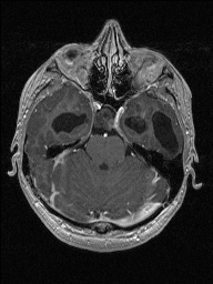 Central neurocytoma (Radiopaedia 56690-63469 Axial T1 C+ 50).jpg