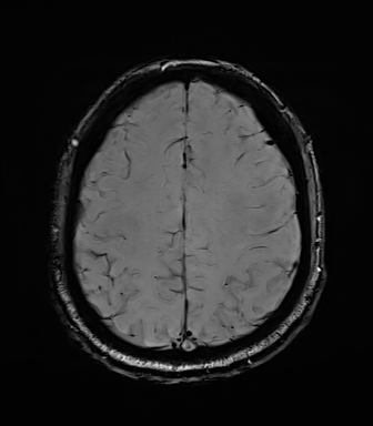 File:Central neurocytoma (Radiopaedia 71068-81303 Axial SWI 48).jpg
