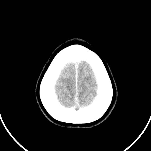Central neurocytoma (Radiopaedia 84497-99871 Axial non-contrast 49).jpg