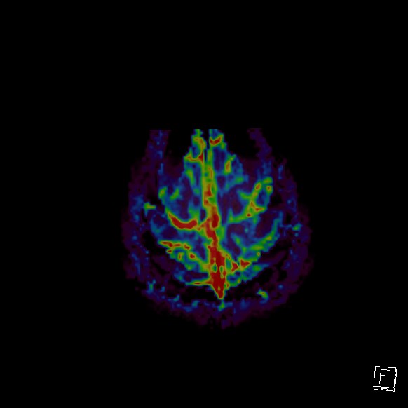 Central neurocytoma (Radiopaedia 84497-99872 Axial Perfusion 21).jpg