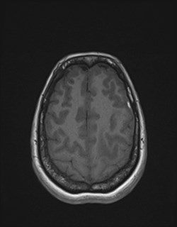 File:Central neurocytoma (Radiopaedia 84497-99872 Axial T1 156).jpg
