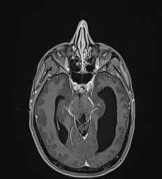 Central neurocytoma (Radiopaedia 84497-99872 Axial T1 C+ 60).jpg
