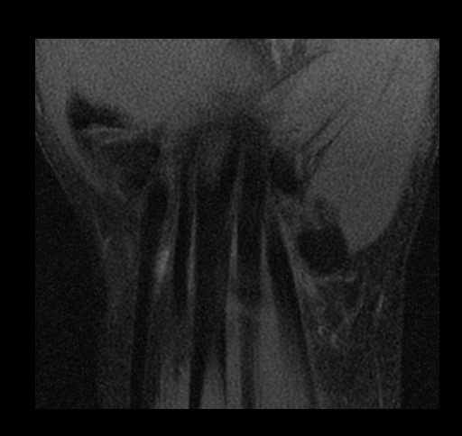 File:Central triangular fibrocartilage perforation (Radiopaedia 73346-84130 Coronal T1 fat sat 13).jpg