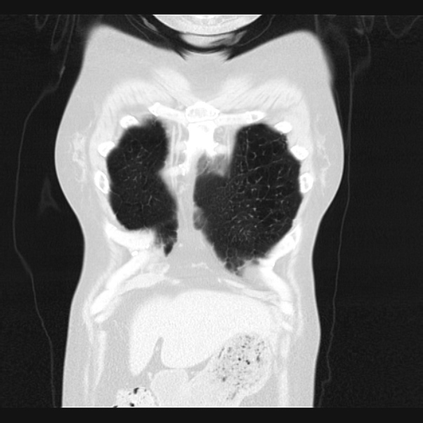Centrilobular pulmonary emphysema (Radiopaedia 24495-24789 Coronal lung window 7).jpg