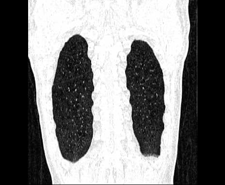 Centrilobular pulmonary emphysema (Radiopaedia 62468-70718 Coronal lung window 65).jpg