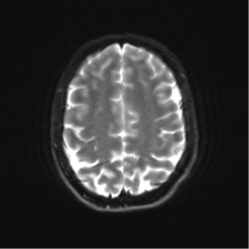 Cerebellar agenesis with hypoplastic pons (pontocerebellar hypoplasia) (Radiopaedia 57224-64138 Axial DWI 29).png