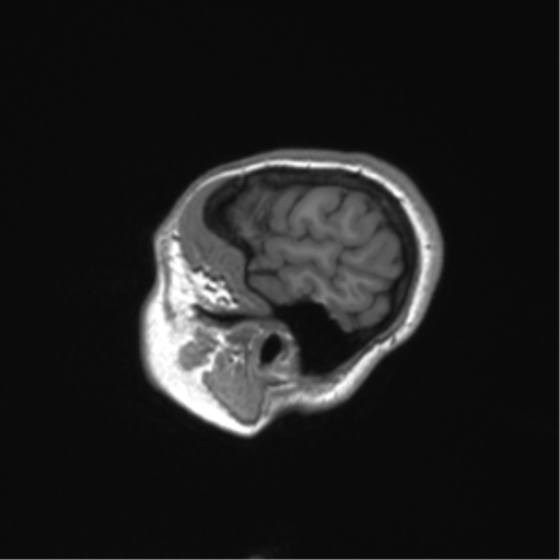 File:Cerebellar agenesis with hypoplastic pons (pontocerebellar hypoplasia) (Radiopaedia 57224-64138 Sagittal T1 14).png