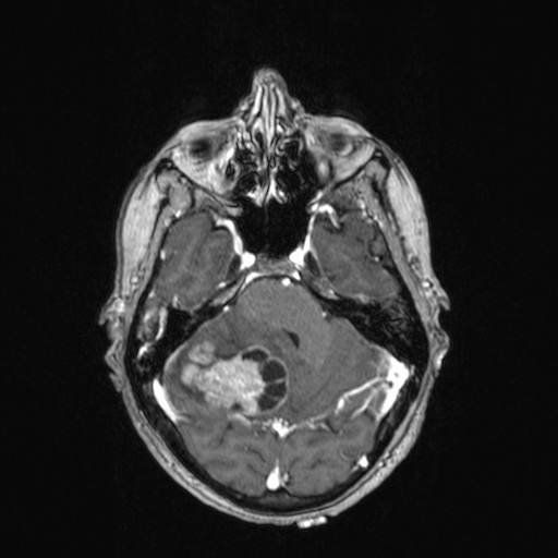 Cerebellar metastases (Radiopaedia 24038-24249 Axial T1 C+ 34).jpg