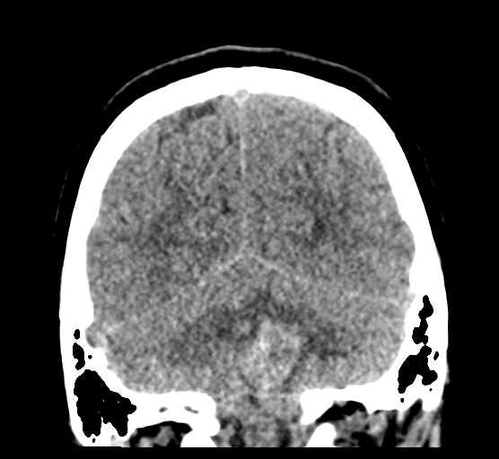 Cerebellar metastases - colorectal adenocarcinoma (Radiopaedia 40947-43652 Coronal non-contrast 73).png