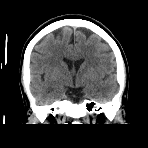 Cerebellar metastasis (cystic appearance) (Radiopaedia 41395-44258 Coronal non-contrast 31).png
