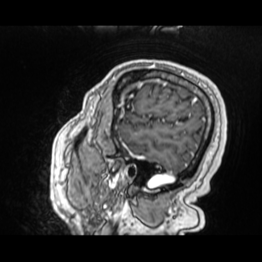 Cerebellar metastasis of pulmonary adenocarcinoma, cavernous venous malformation, and developmental venous anomaly (Radiopaedia 85827-101661 Sagittal T1 C+ 79).jpg