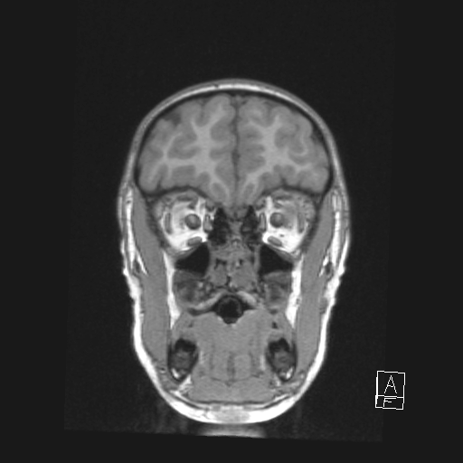 Cerebellar stroke (Radiopaedia 32202-33150 Coronal T1 11).png