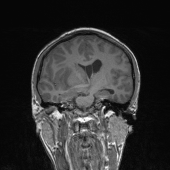 Cerebral abscess and subdural empyema (Radiopaedia 84436-99779 Axial FLAIR 19).jpg
