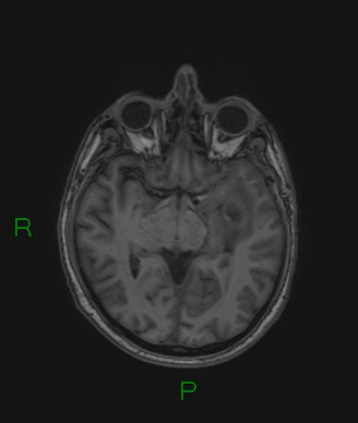 Cerebral abscess and subdural empyema (Radiopaedia 84436-99779 Axial T1 49).jpg