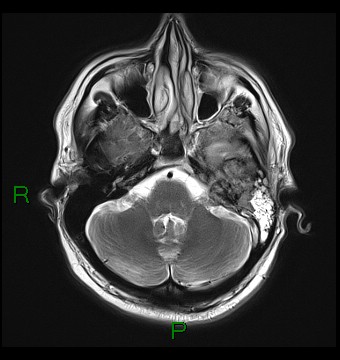 File:Cerebral abscess and subdural empyema (Radiopaedia 84436-99779 Axial T2 6).jpg