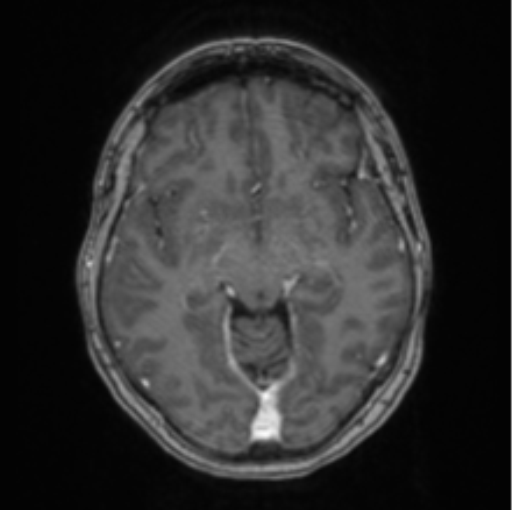 Cerebral abscess from pulmonary arteriovenous malformation (Radiopaedia 86275-102291 Axial T1 C+ 34).png