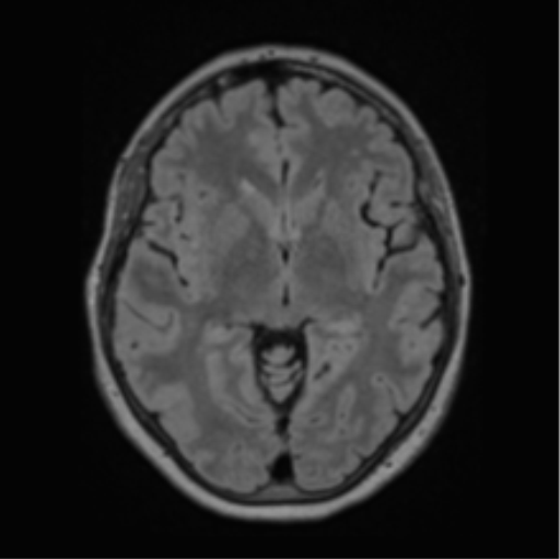 File:Cerebral abscess from pulmonary arteriovenous malformation (Radiopaedia 86275-102291 J 37).png