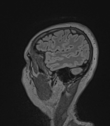 Cerebral abscess from pulmonary arteriovenous malformation (Radiopaedia 86275-102291 Sagittal FLAIR 14).png