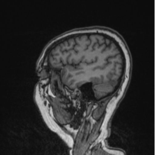 Cerebral abscess from pulmonary arteriovenous malformation (Radiopaedia 86275-102291 Sagittal T1 31).png