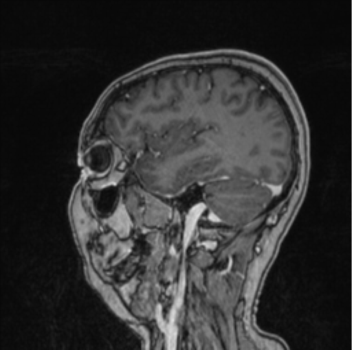 Cerebral abscess from pulmonary arteriovenous malformation (Radiopaedia 86275-102291 Sagittal T1 C+ 22).png