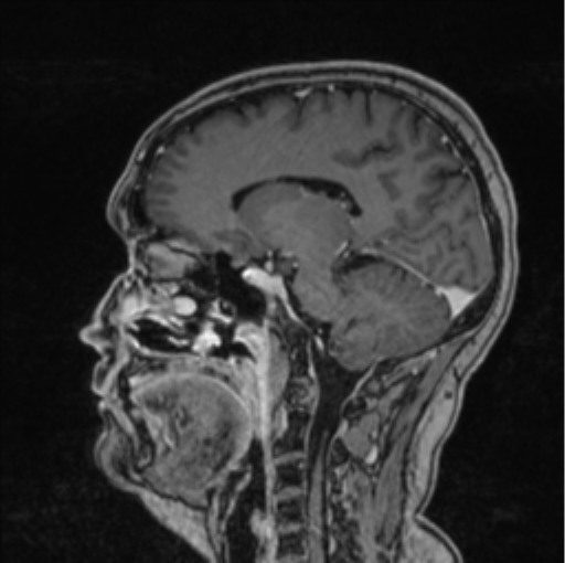 Cerebral abscess from pulmonary arteriovenous malformation (Radiopaedia 86275-102291 Sagittal T1 C+ 34).png