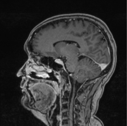 Cerebral abscess from pulmonary arteriovenous malformation (Radiopaedia 86275-102291 Sagittal T1 C+ 35).png
