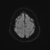 Cerebral amyloid angiopathy-related inflammation (Radiopaedia 74836-85849 Axial DWI 55).jpg