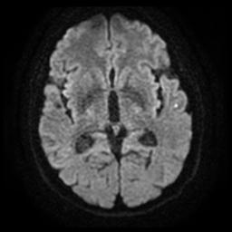Cerebral amyloid angiopathy (Radiopaedia 28698-28978 Axial DWI 14).jpg