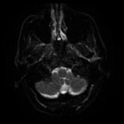 File:Cerebral amyloid angiopathy (Radiopaedia 28698-28978 Axial DWI 31).jpg