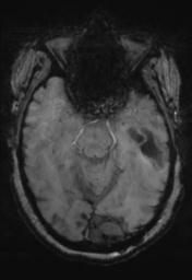 File:Cerebral amyloid angiopathy (Radiopaedia 29129-29518 Axial SWI Magnitude 12).jpg