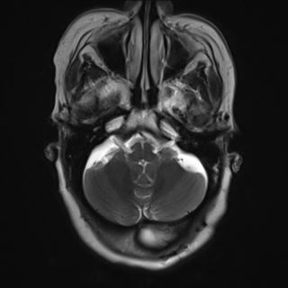 File:Cerebral amyloid angiopathy (Radiopaedia 29129-29518 Axial T2 4).jpg