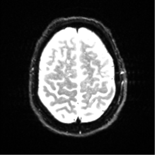 File:Cerebral amyloid angiopathy (Radiopaedia 46082-50433 Axial DWI 22).png