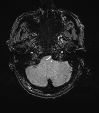 File:Cerebral amyloid angiopathy (Radiopaedia 46082-50433 Axial SWI 11).png