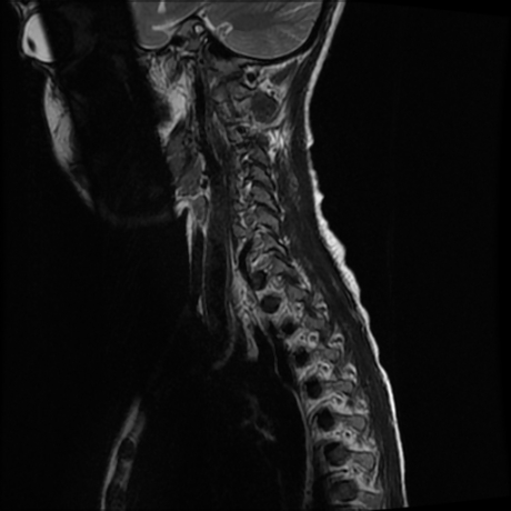 File:Cerebral and spinal tuberculosis (Radiopaedia 90489-107838 Sagittal 1).jpg