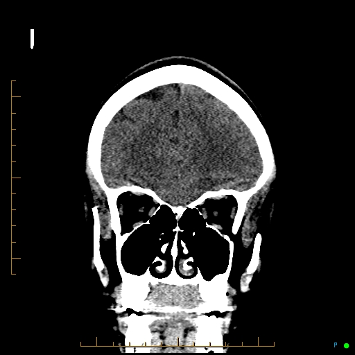 Cerebral arteriovenous malformation (AVM) (Radiopaedia 78162-90706 Coronal non-contrast 25).jpg