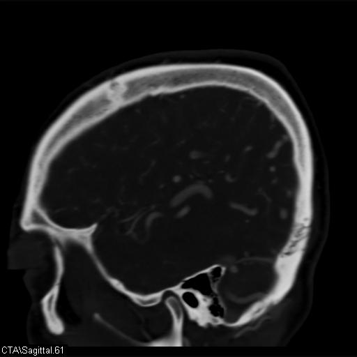 Cerebral arteriovenous malformation (Radiopaedia 28518-28759 D 58).jpg
