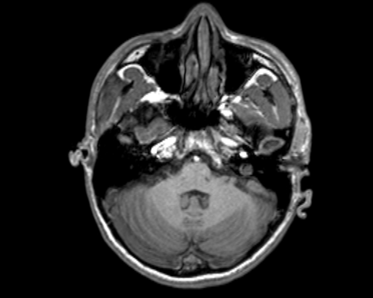 Cerebral arteriovenous malformation (Radiopaedia 30198-30813 Axial T1 45).jpg