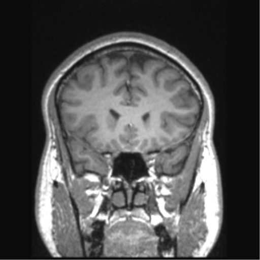 File:Cerebral arteriovenous malformation (Radiopaedia 39259-41506 Coronal T1 65).png