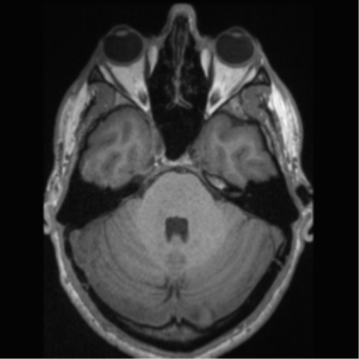 Cerebral arteriovenous malformation (Radiopaedia 55798-62372 Axial T1 16).png