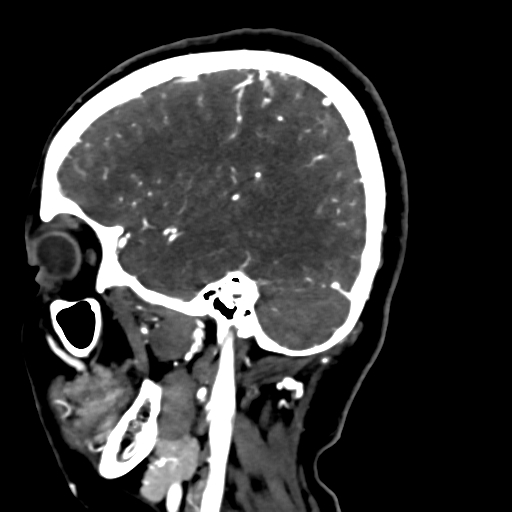 File:Cerebral arteriovenous malformation (Radiopaedia 73830-84645 Sagittal C+ delayed 69).jpg