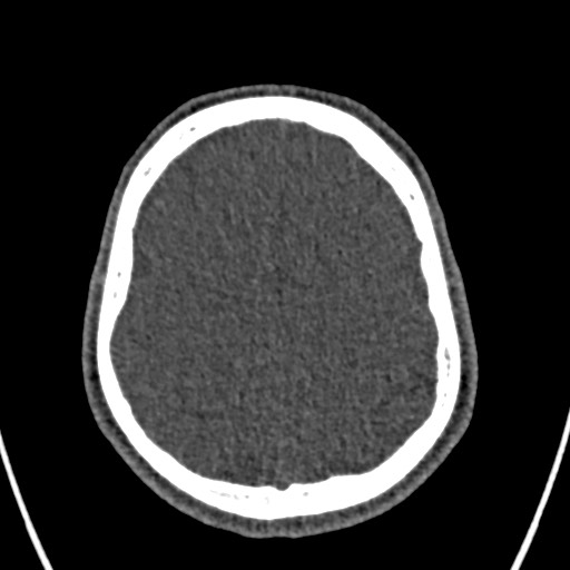 Cerebral arteriovenous malformation (Radiopaedia 78188-90746 Axial non-contrast 138).jpg