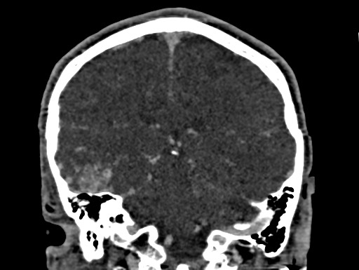 Cerebral arteriovenous malformation (Radiopaedia 78188-90746 Coronal C+ delayed 76).jpg