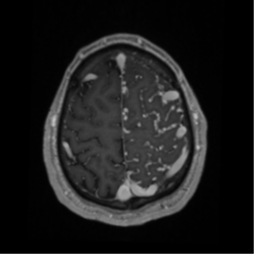 Cerebral arteriovenous malformation - huge (Radiopaedia 35734-37272 Axial T1 C+ 62).png