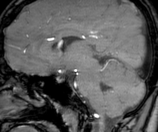Cerebral arteriovenous malformation at posterior body of corpus callosum (Radiopaedia 74111-84925 J 180).jpg