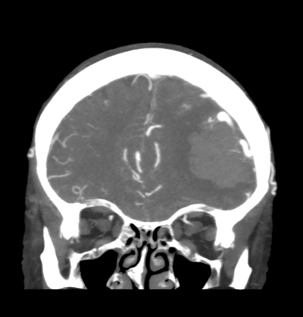 Cerebral arteriovenous malformation with lobar hemorrhage (Radiopaedia 44725-48511 B 15).png